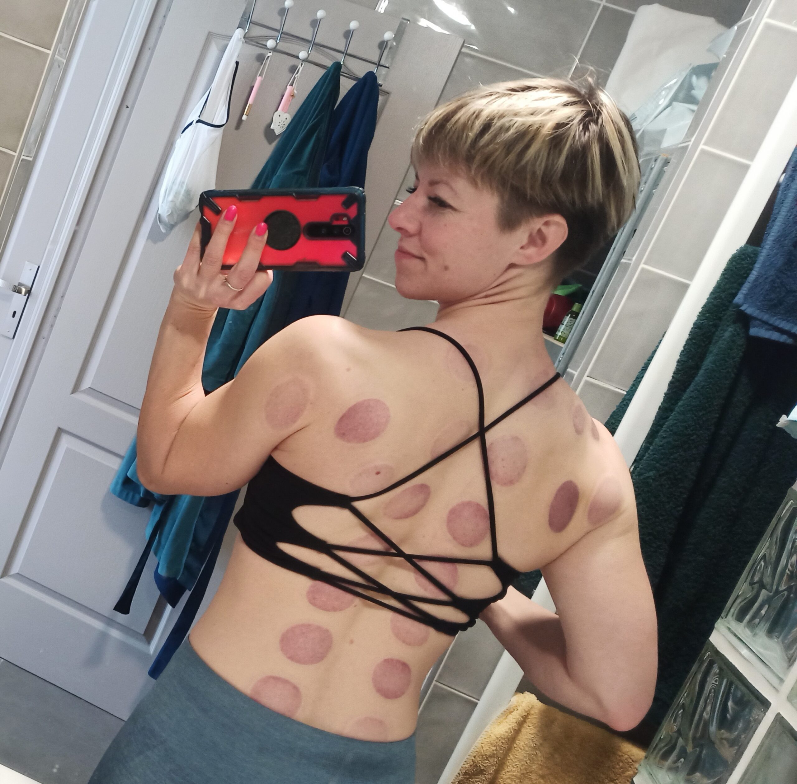 Cupping marks